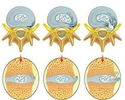 脊柱退變_脊柱退變治療-產品列表頁-盤錦骨科醫院