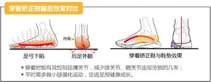 愛矯健護足課堂:扁平足要注意科學選鞋