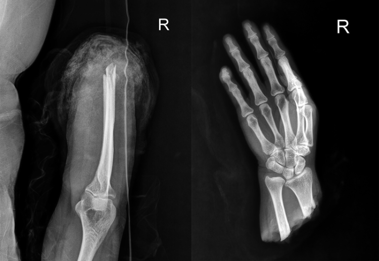爭分奪秒,斷臂重生重慶長城骨科醫院完成一例完全離斷肢體再植手術