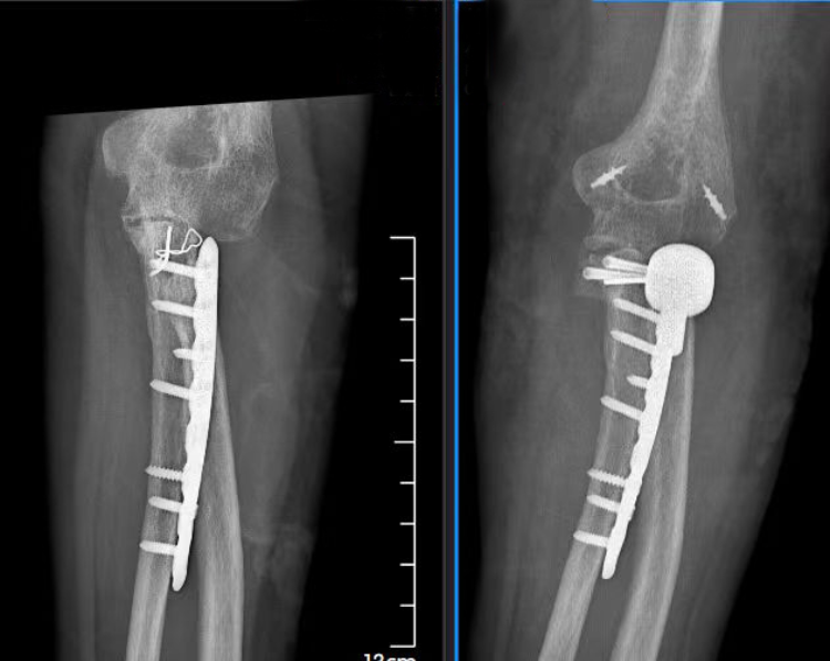 意外摔成肘關節“恐怖三聯征”重慶長城骨科醫院專家團隊妙手解病痛