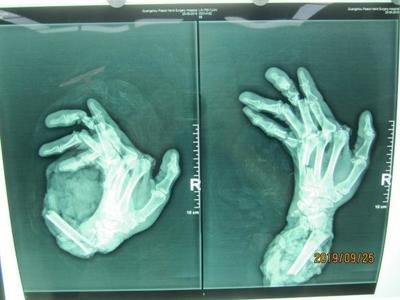 廣州阿伯右手卷入機器“骨肉分離”,醫生11小時幫他接回手臂